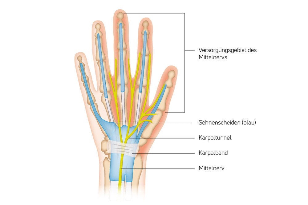 Anatomie Sehnen Hand mit Beschriftung, Handorthesen
