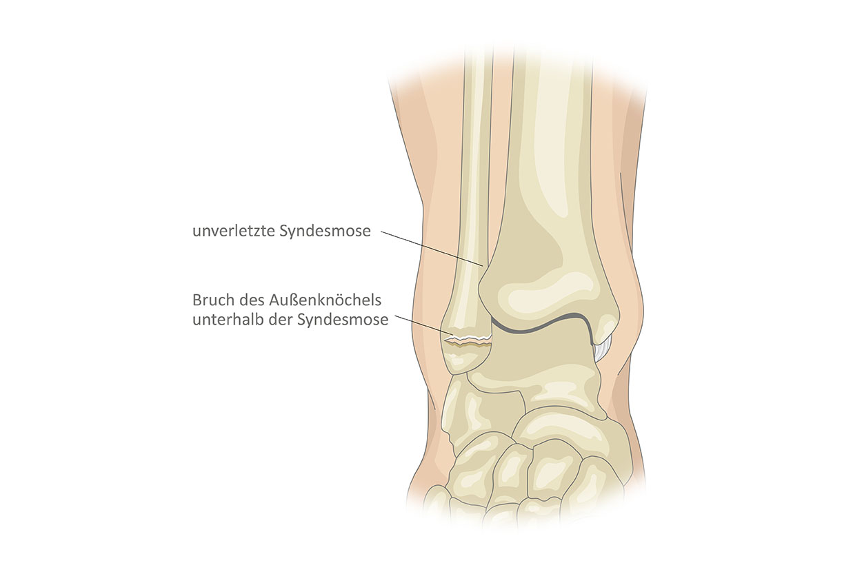 Anatomiegrafik Sprunggelenk, Weber Fraktur A beschriftet, Website