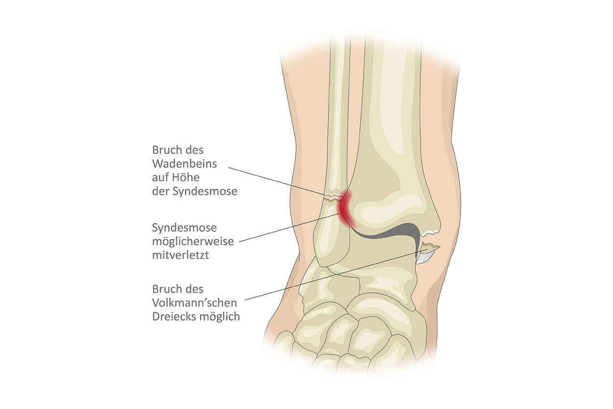 Anatomiegrafik Sprunggelenk, Weber Fraktur B beschriftet, Website